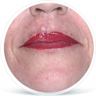 JIZVA-RET_PO_APLIKACI