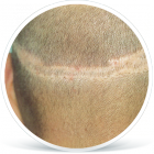 jizva_po_implantatech_vlasu