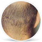 kamuflaz_jjizvy_po_implantatech_vlasu